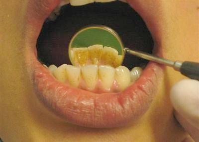 Mundhygiene vorherjpg